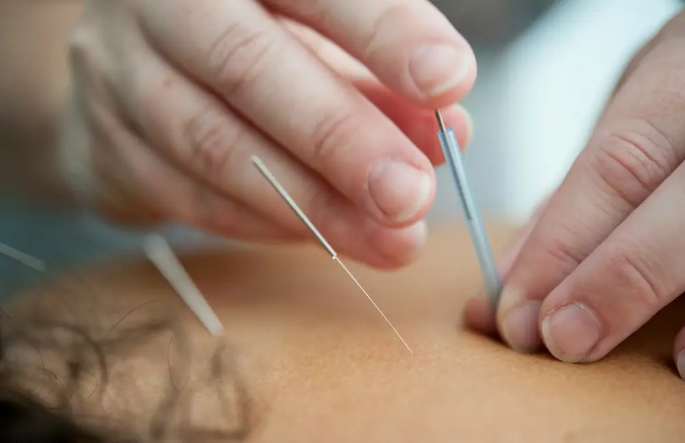 Acupuncture needles being placed by a practitioner